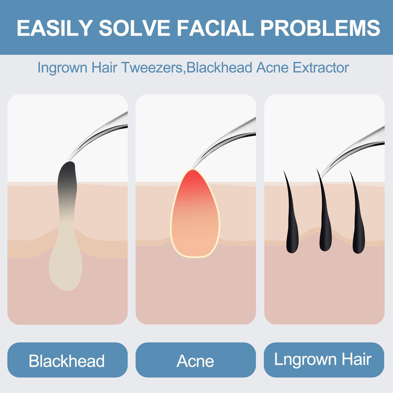 60PCS Dual Heads Blackhead Remover, Pimple Comedone Extractor, Acne Whitehead Blemish Removal Kit, Premium Stainless Steel Pimple Popper Tool kit, Risk Free for Face Skin, with Portable Box