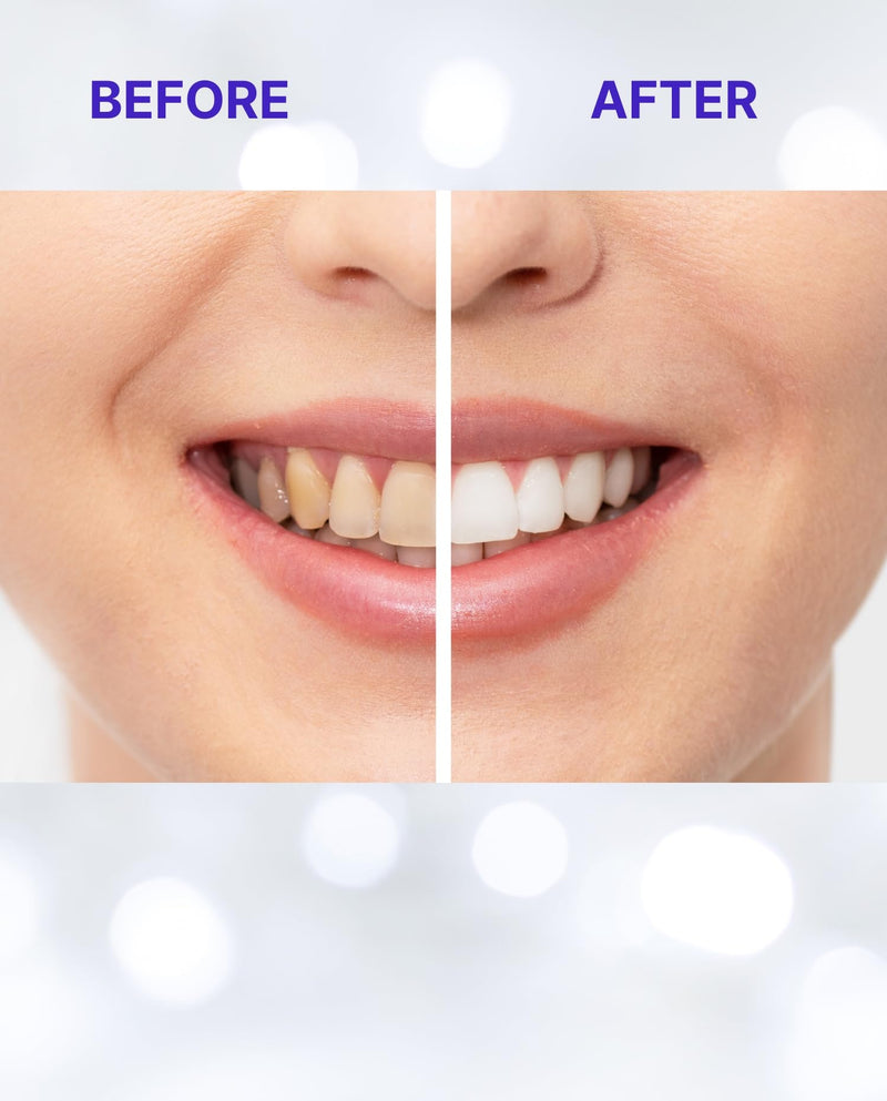 [Australia] - Teeth Whitening Strips, 14 Pack, Removes Surface Stains for Brighter Smile 