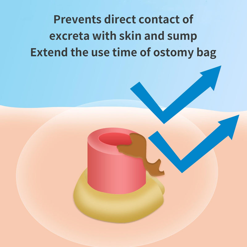 [Australia] - Ostomy Paste, Alcohol-Free Skin Barrier Ostomy Paste, Stoma Care Supplies Osotmy Supplies Accessories,Ostomy Bag Protect Skin Barrier Adhesive & Filler-2.1 Ounce Tube 