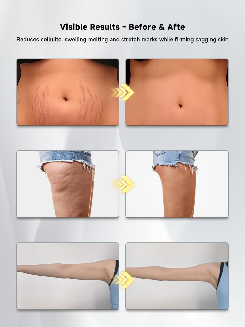 [Australia] - Lymphatic Drainage Massager & Anti Cellulite Massage Tool, Helps Reduce Stretch Marks & Cellulite, for Legs, Arms & Belly, Body Sculpting Machine with Microcurrent & Red-Light & Heat & Vibration 