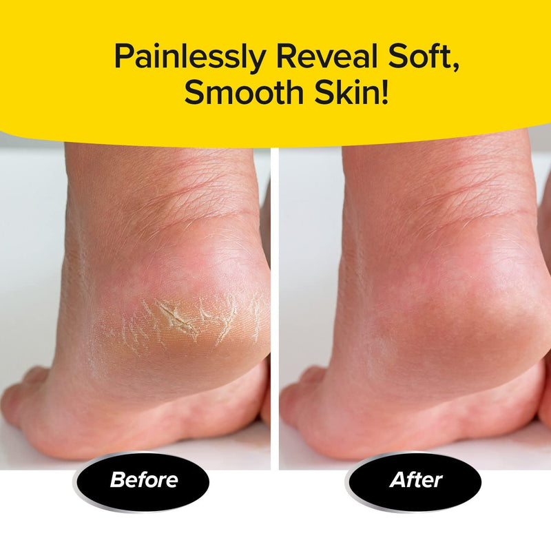 [Australia] - PedEgg Power Cordless Motorized Callus Remover w/ Bright LED Light As Seen On TV, Quickly Removes Calluses & Dry Skin w/ 2000 RPMs of Spinning Action for Smooth, Soft Feet, Easy-Grip Ergonomic Handle 
