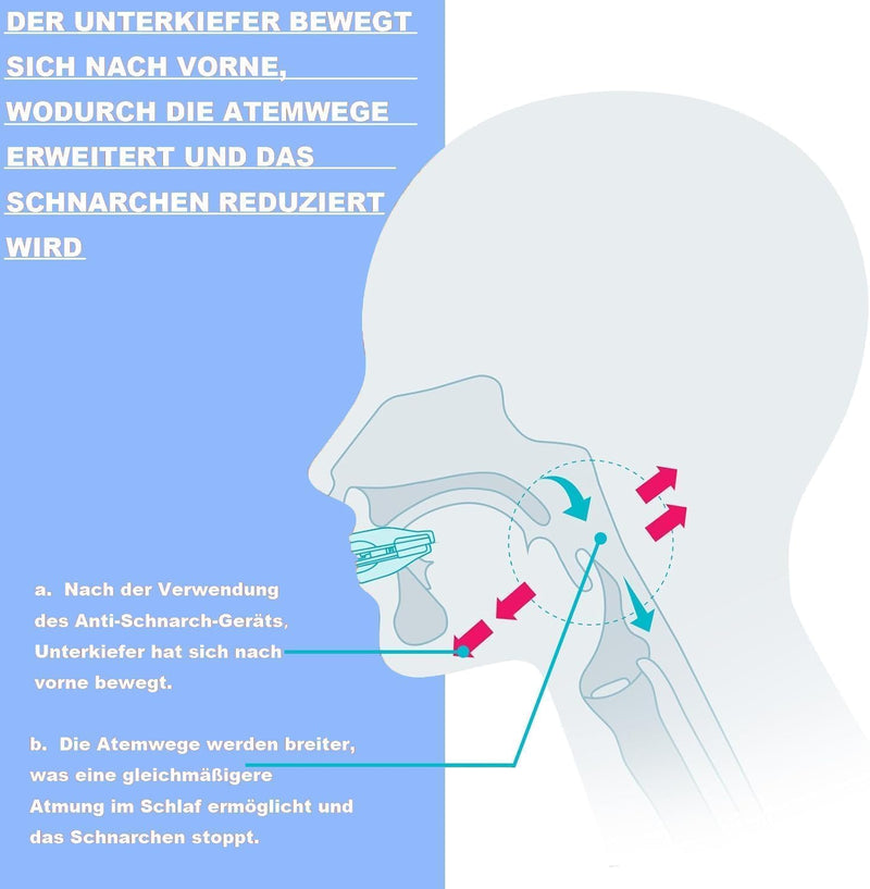 [Australia] - Snoring splint, anti-snoring splint, snoring stopper, snoring-free pro, snoring splint for men and women, anti-snoring mouthpiece (blue, 1 generation) blue 