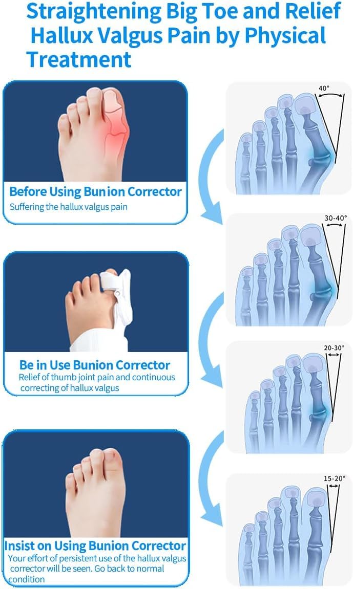 [Australia] - Bunion Corrector for Man and Women Big Toe, Bunion fix, Adjustable Splint for Bunion Relief, Suitable for Left and Right Feet (02) 02 