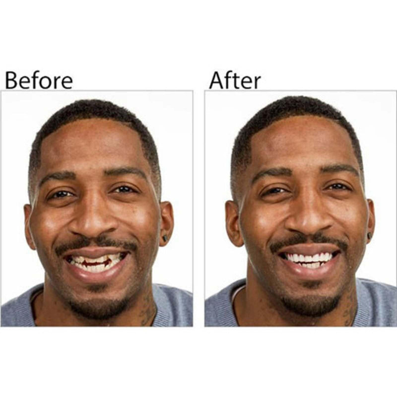 [Australia] - 2 Pairs, Regain Confidence Smile for Women and Men, Temporarily Adjustable 1 