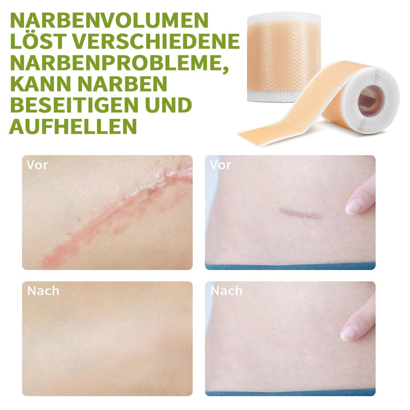 [Australia] - Scar plaster, silicone plaster for scars, silicone scar tape, reusable silicone scar plaster, medical scar treatment for all skin types, safe and effective (4 cm x 150 cm roll) colour 