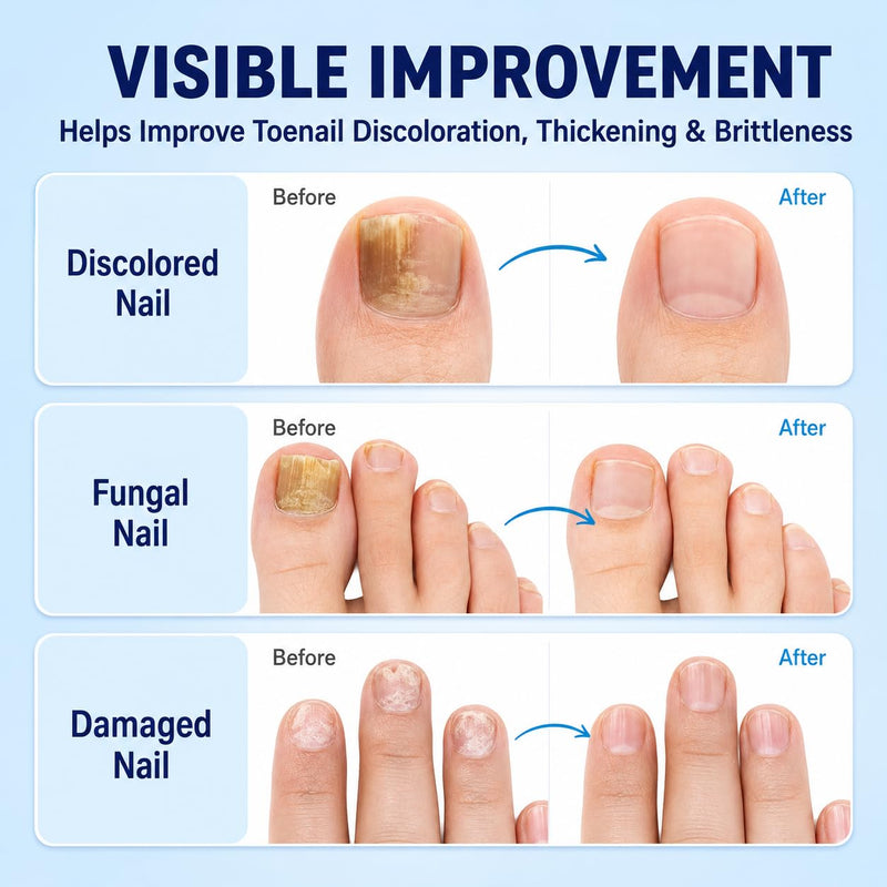 Nail Renewal Treatment Extra Strength: 25% Undecylenic Acid OTC Formula – Toenail Nail Care Kit with Brush & File for Ingrown Nails, Discoloration & Brittle Nails, Thick-Looking, Rough-Looking