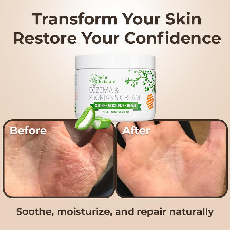 Wild Naturals Eczema & Psoriasis Cream for Dry, Itchy Skin – Eczema Relief for Adults & Kids – Moisturizing Psoriasis Cream with Manuka Honey 4 Ounce (Pack of 1)