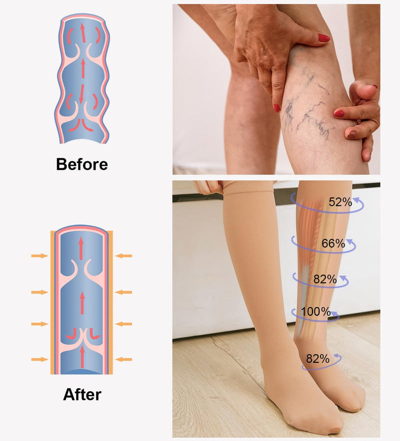 [Australia] - 2 pairs of medical compression stockings for women and men, 20-30 mmHg, class 2, closed toe area, graduated support, support stockings for varicose veins, edema, flight L, 2 x beige 