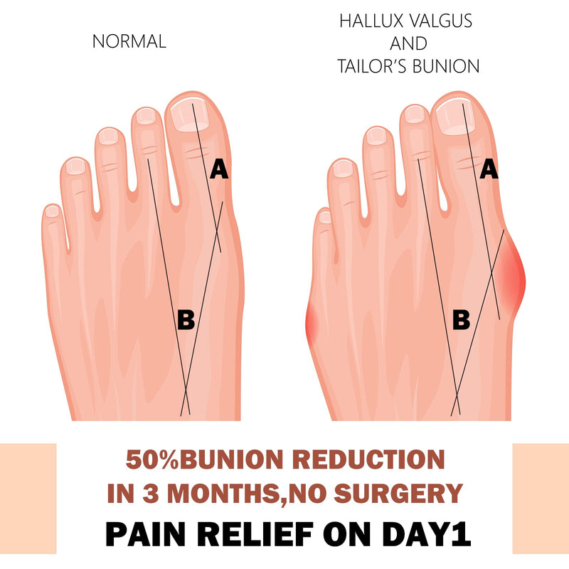 [Australia] - 200 Pcs Toe Bunion Pain Relief Tape Pre Cut Bunion Kinesiology Tape Bunion Support Bunion Correction and Pain Relief Tape Big Toe Sprains Anti Sensitive and Waterproof for Women and Men 