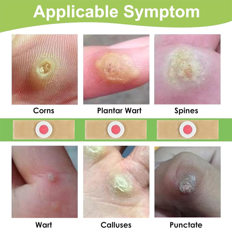 [Australia] - Corn plaster, 30 pieces corn removal pads, corn removal plaster, corn removal on the sole of the foot, corn remover pads, corn removal plaster 
