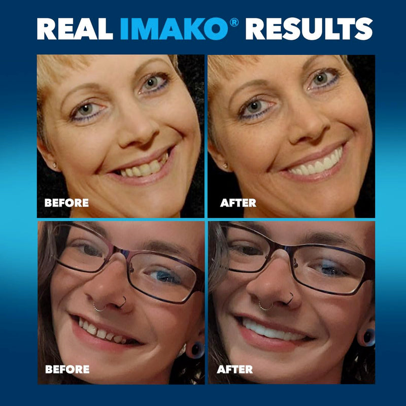 [Australia] - Imako Premium Cosmetic Teeth - 1 Pack - Large, Bleached White - Upper Veneers - Custom Fit at Home, DIY Smile Makeover, Made in USA 