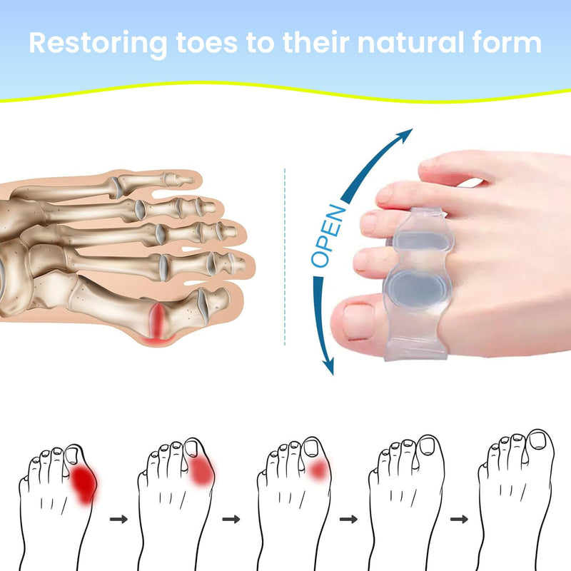 [Australia] - Bunion Corrector for Man and Women Big Toe, Bunion fix, Adjustable Splint for Bunion Relief, Suitable for Left and Right Feet (02) 02 