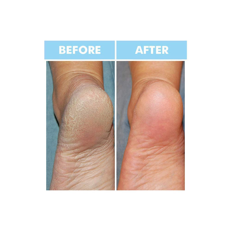 [Australia] - Bodipure Premium Hand and Foot Mask | Moisturizing Kertain Gloves & Socks | Hydrating Dull Dry Hands, Cracked Heels, Callus Softening & Nail Strengthening | Chemical-Free Feet Treatment | (6+6 Pack) 