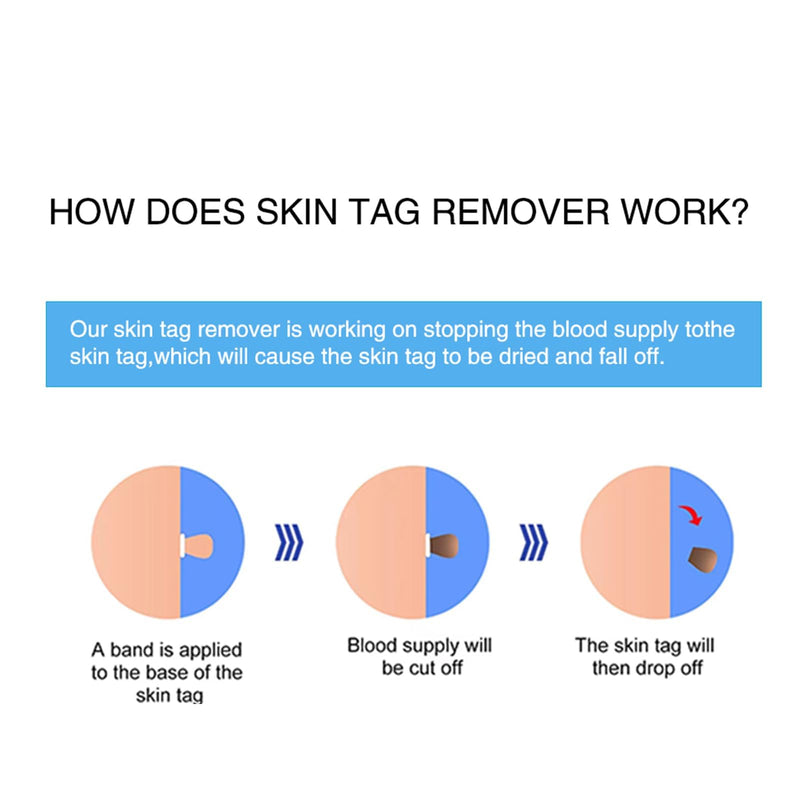 [Australia] - Tag Remover Device, Stalk Wart Removal Device, 3 in 1 Skin Tag Fibroma Removal Quick Kit, Safe for Face, Neck and Body Azure Blue 