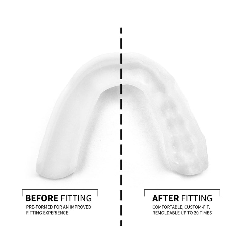 [Australia] - SOVA 3D Night Guard with Case - 2.0mm Thin - Custom-Molded Fit - Protects Against Nighttime Teeth Grinding & Clenching - Odor & Taste Free - Remoldable Up to 20 Times - Non Toxic Preformed 