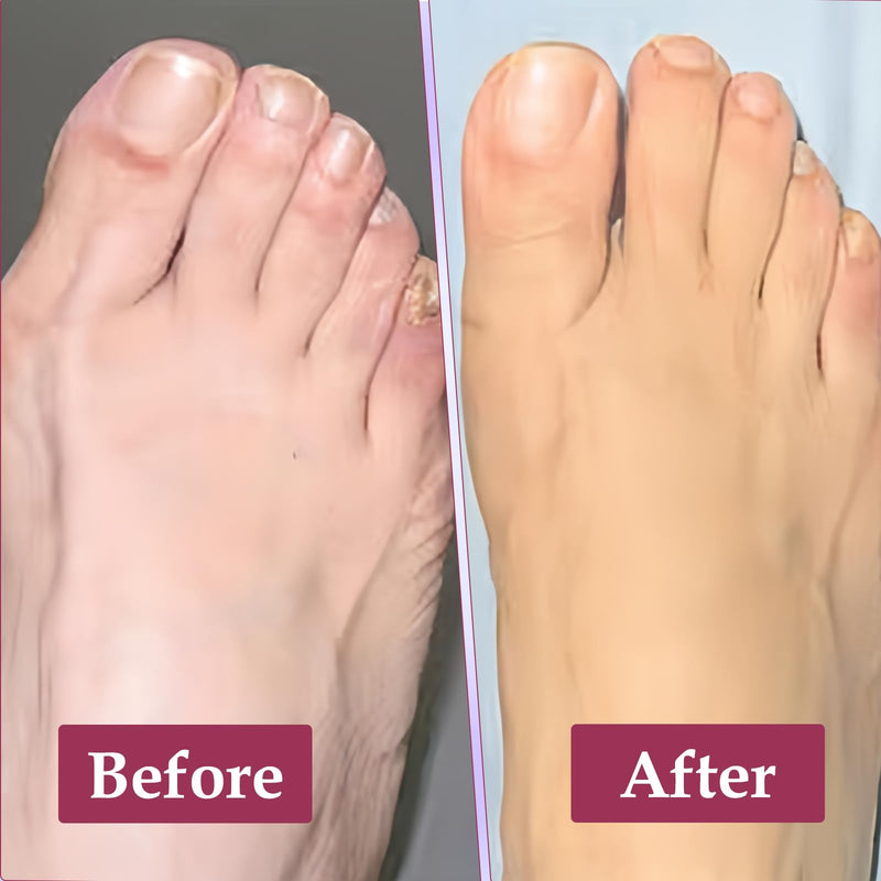 [Australia] - Pack of 6 silicone toe spacers, toe spacers separators, silicone toe separators, correction toe spacers, gel toe separators, hallux valgus correction set for big toes 