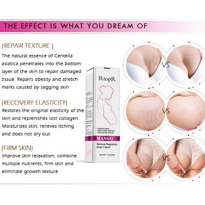[Australia] - Mango Stretch Marks and Scar Cream, Stretch Marks and Scar Removal Cream for Pregnancy, Stretch Marks Scar Belly Creams for Wrinkles, Obesity Fat Stretch Mark Moisturizing, Remove Marks (40g) 