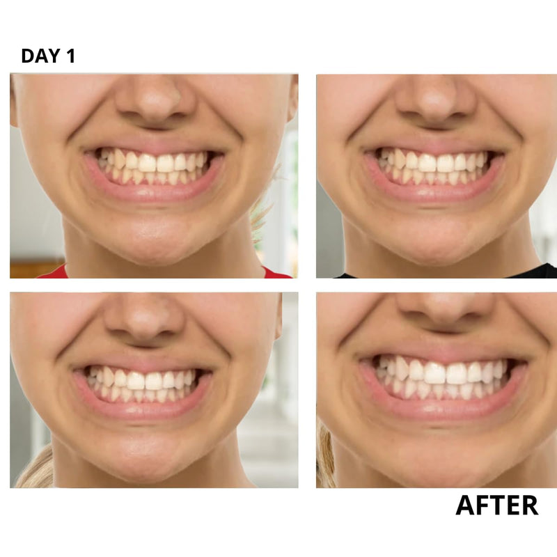 InstantGlo Teeth Whitening Kit with 32X LED Light, 35% Carbamide Peroxide Whitening Gel Pens, Fast Teeth Whitener for Sensitive Teeth, Enamel-Safe, Dentist-Trusted incl. Mouth Tray