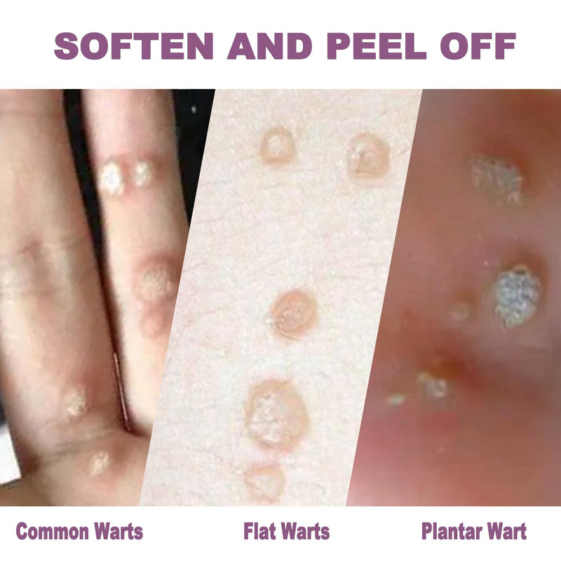 [Australia] - Liquid Wart & Corn Gel 30 ml, Maximum Strength Salicylic Acid Wart Liquid Fast-Acting for Plantar, Common and Flat,Safe for Children and Adults,1.04oz 