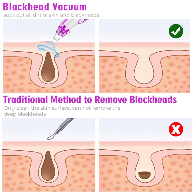 Blackhead Remover Pore Vacuum Upgraded Facial Pore Cleaner Electric Comedone Whitehead Extractor Tool, Blackhead Vacuum Kit for Women & Men