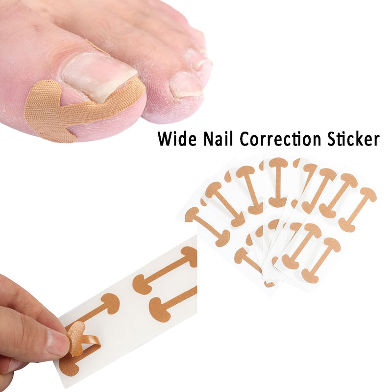 Professional Ingrown Toenail Treatment Set with Breathable Ingrown Toenail Strips,Ingrown Toenail Removal Kit,Curved Toenails Corrector Patch, Ingrown Toenail Corrector Tool Set for Home Use
