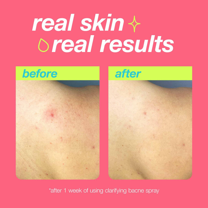 [Australia] - Dermalogica Clear Start Clarifying Bacne Spray - Back Acne Treatment Spray for Body Breakout, Pore Clearing, Preventing Pimple with Salicylic Acid, Witch Hazel, Tea Tree Oil, All Skin Type - 6 fl oz 