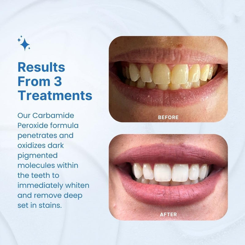 PurelyWHITE DELUXE Teeth Whitening Kit, Complete LED Teeth Whitening, 15+ Treatments, (3) 3ml Whitening Gel Syringes, Whiter Smile in 7 Minutes 0.2 Fl Oz (Pack of 5)