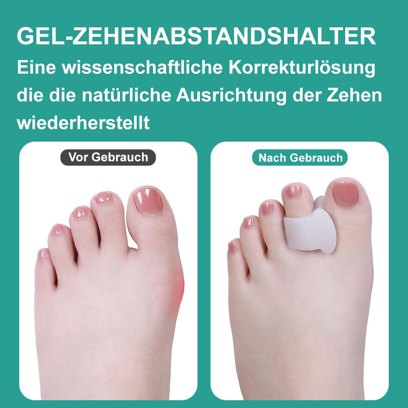 [Australia] - Sosede Pack of 8 silicone toe separators for hallux valgus correction - women and men, silicone toe separators, hammer toe correction, toe protection, toe spacer and stretcher 