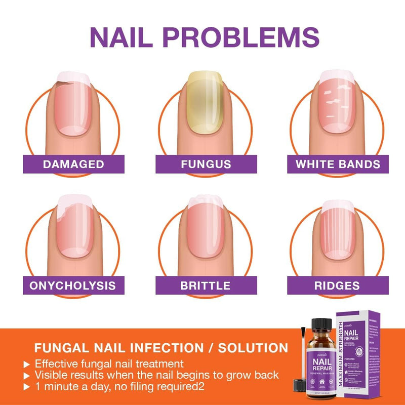 [Australia] - Toenail Fungus Treatment Extra Strength for Toenails and Fingernail Discoloration 1.0 Oz Drop 1 Fl Oz (Pack of 1) 