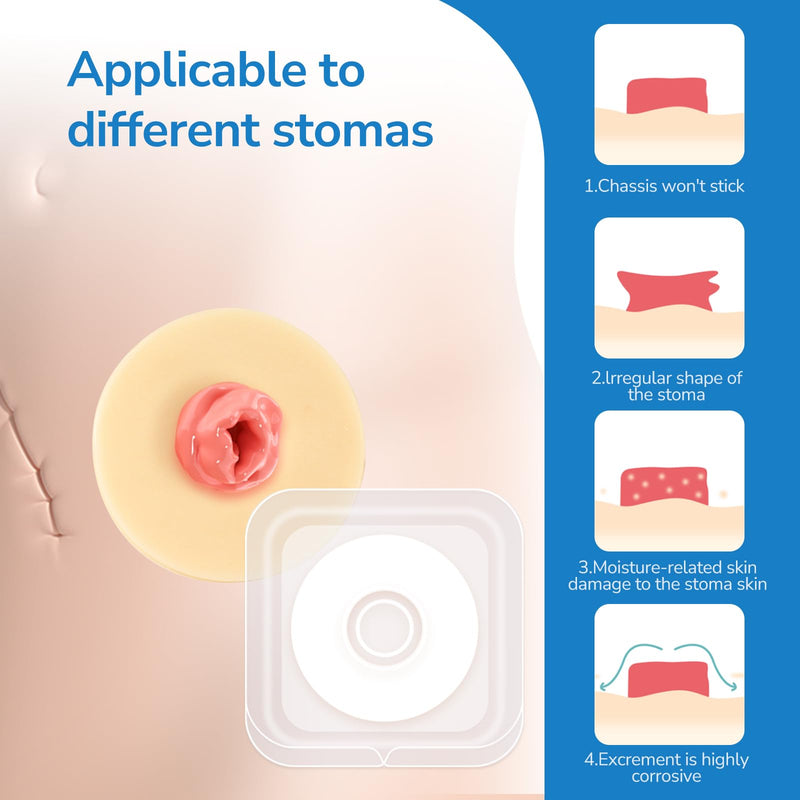 [Australia] - 10PCS Ostomy Barrier Rings, Ostomy Supplies, 2mm Thickness Moldable Ostomy Rings Medical Grade Hydrocolloid Adhesive Barrier Rings Better Seal for Ostomy Bags (Box of 10) 2mm Ostomy Barrier Rings 