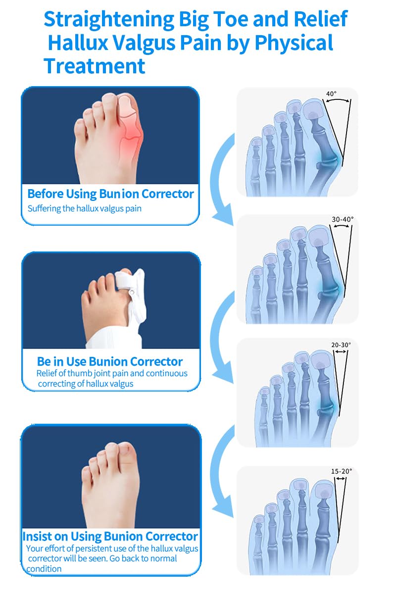 [Australia] - Generic Bunion Corrector for Hallux Valgus, Adjustable Knob Bunion Splint, Toe Straightener with Non-Slip Heel Strap, Toe Separator, Day and Night Support., White 