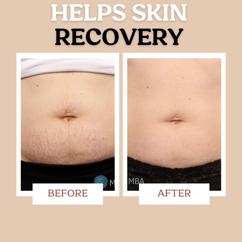 [Australia] - Roe Wellness Stretch Mark Cream for Sensitive Skin Plant-Based Long and Short-term Hydration, Increases Skin Elasticity and Firmness (Stretch Mark Cream) 