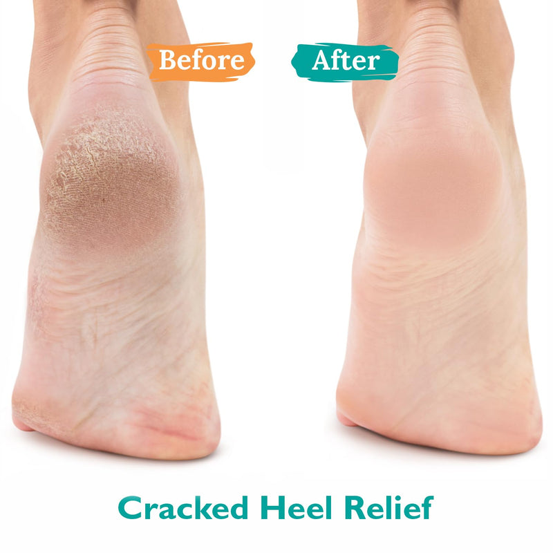 GILDEN TREE Urea Gel 42 Percent For Feet Maximum Strength Softens Cracked Heel Calluses & Thick Toenails 42% Urea Gel