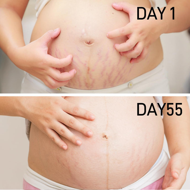 [Australia] - PEGO Stretch Mark Oil for Pregnancy, Maternity Body Oil for Stretch Mark Prevention & Reduction, Hydrating Skin Care, 5.41oz (Oil+Cream) Oil+Cream 
