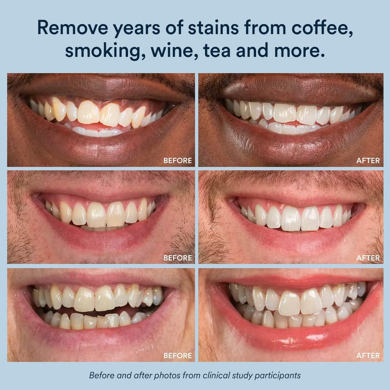 [Australia] - Auraglow 9% Teeth Whitening Gel Syringe Refill Pack, 9% Hydrogen Peroxide, 30 Whitening Treatments, (3) 5mL Whitening Gel Syringes, Sensitive Teeth Whitening 9% Hydrogen Peroxide - Mint 