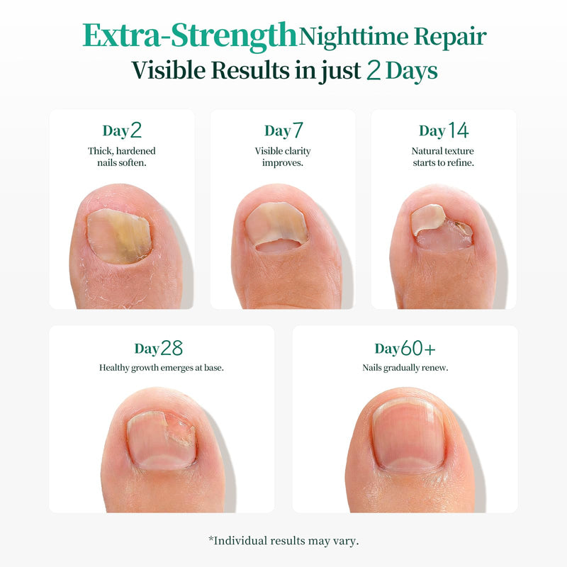 APUREE Fungal Nail Patches Extra Strength: 1% Tolnaftate Nail Repair 64PCS | FSA-HSA Eligible With NDC 84167-332-23, Trim To Fit, Breathable, Restores Discolored Yellow Thick Nails, With Precision File