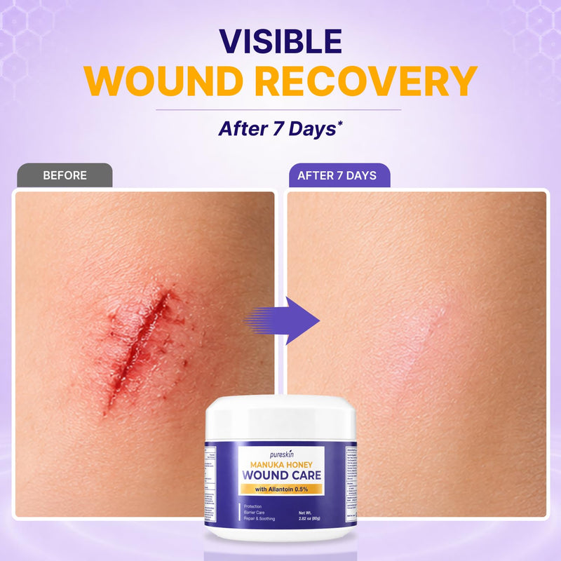 PURESKIN Manuka Honey Wound Care Ointment 2.82 oz (80 g): Manuka Honey Medical Grade Gel for Wounds, Cuts, Scrapes & Burns with Allantoin 0.5%, Tallow & Vitamin E - Fragrance-Free 2.82 Ounce (Pack of 1)