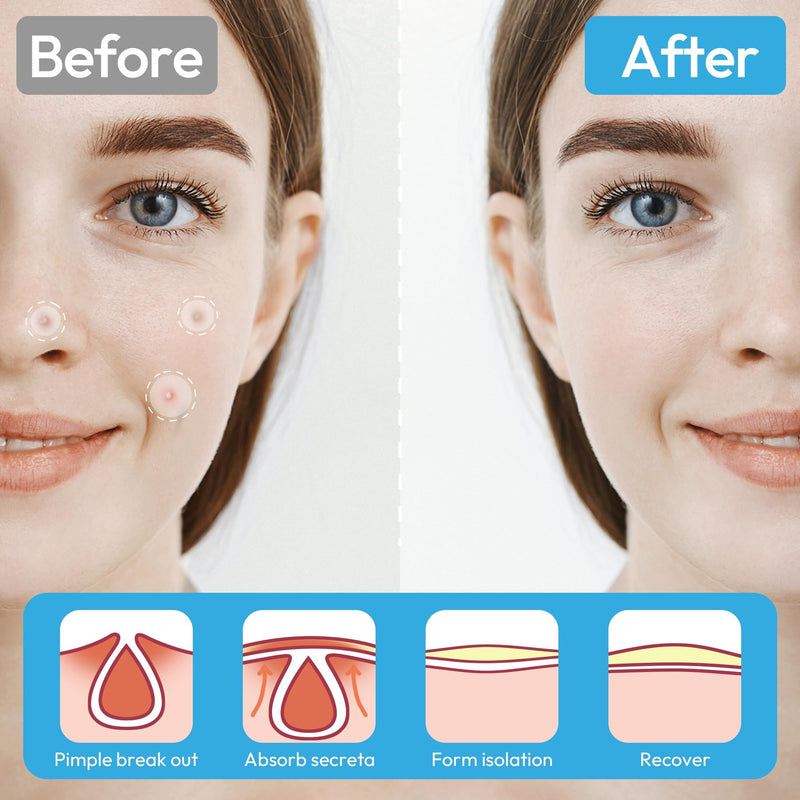 [Australia] - Pimple Patches for Face, Hydrocolloid Ace Patches, Zit Patches for Day and Night Invisible with Tea Tree, Salicylic Acid & Cica Oil-280 Patches,5 Size,2 Thickness 