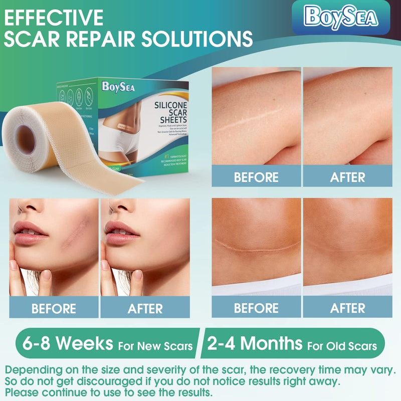 [Australia] - Professional Silicone Scar Sheets (1.6" x 150" Scar Roll-3.8M) - Scars Removal Treatment - Reusable Silicone Scar Tape Strips Type for Keloid, C-Section, Surgery, Burn, Acne et Natural 