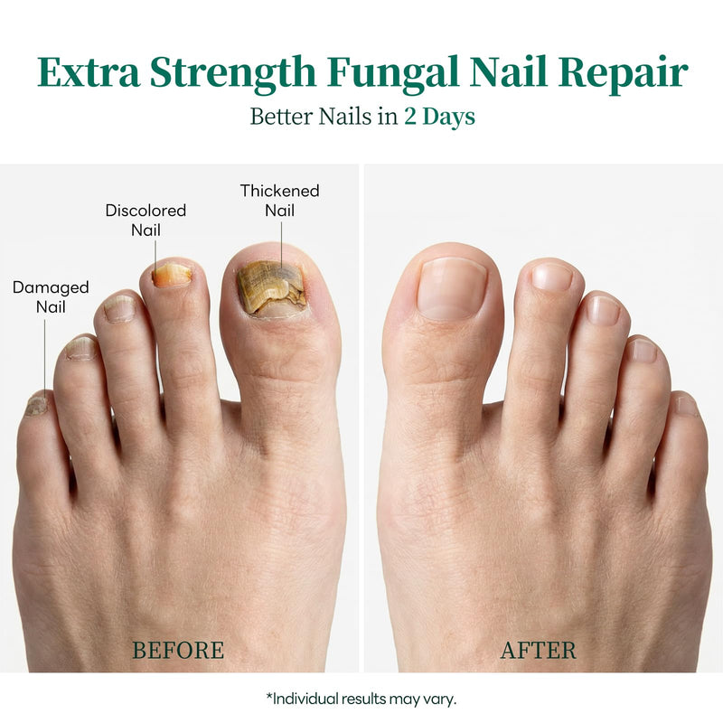 Apuree Nighttime Antifungal Pen Extra Strength 1% Tolnaftate Overnight | Tea Tree Oil, FSA-HSA Eligible, For Discolored Yellow Thick Brittle Damaged Nails, Improves Nail Appearance, Mess-Free