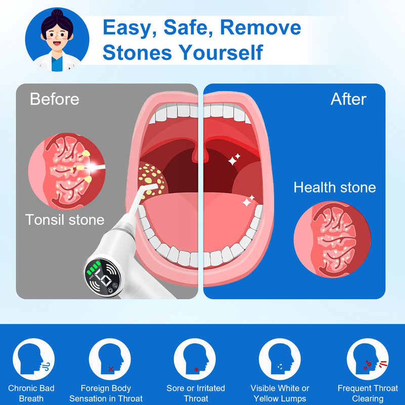 [Australia] - Tonsil Stone Remover Tool, Upgraded Electric Tonsil Stone Removal Kit - with Built-in LED Light & 6-Level Suction for Bad Breath Prevention, Oral Suction Device for Stone Removal White 