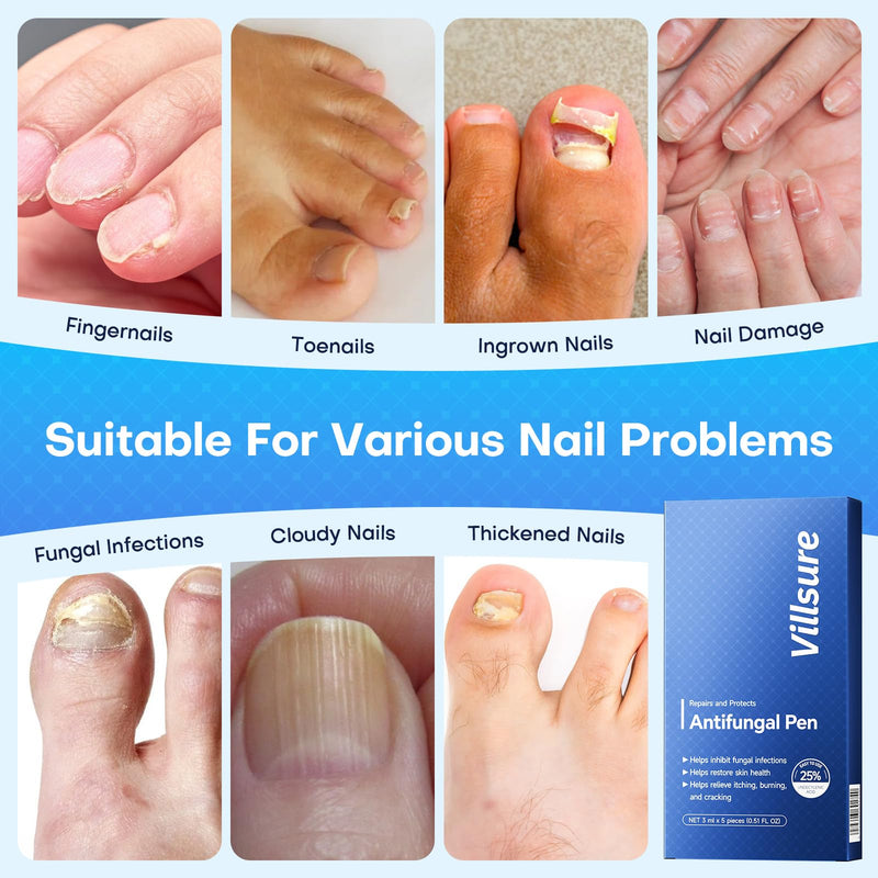 Toenail Fungus Treatment Extra Strength Pen with 25% Undecylenic Acid 5 Pcs | Nail Fungus Pens for Thick, Yellow or Damaged Nails, Formulated with Tea Tree Oils, along with Other Natural Ingredients