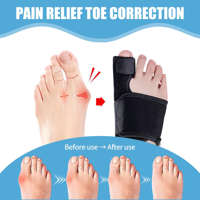 Recovist Bunion Brace for Women & Men - Recovist Bunion Corrector & Big Toe Straightener. alleviation Pain & Corrects Toe Alignment. For Left & Right Foot (1 Pair)