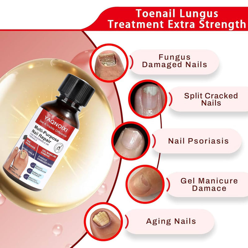 Toenail Fungus Treatment - Fast Acting For Thick, Discolored, Broken & Damaged Toe & Finger Nail, Treats Damaged Nails and Ingrown Toenails - 30ml/1oz (2pcs) 2pcs