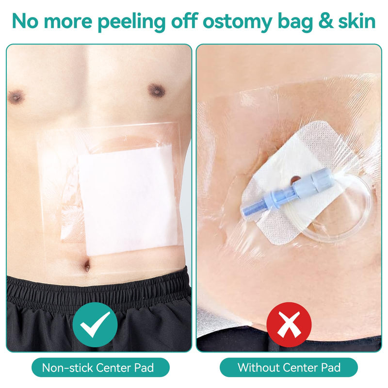 [Australia] - Waterproof Ostomy Bag Shower Cover, Stoma Shower Shields, Adhesive Bandage - No Glue On The Center of The Patch, Colostomy Ilostomy Urlostomy Bathing Bags, Waterproof Dialysis Catheter Cover, 14pcs 