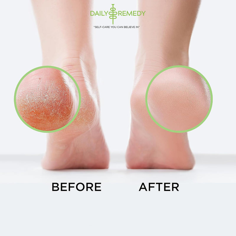 Tea Tree Oil Foot Soak with Epsom Salt - Made in USA - for Toenail irritations, Athletes Foot, Stubborn Foot Odor Scent, Softens Calluses & Soothes Sore Tired Feet - 16 Ounce Tea Tree Oil 1 Pound (Pack of 1)
