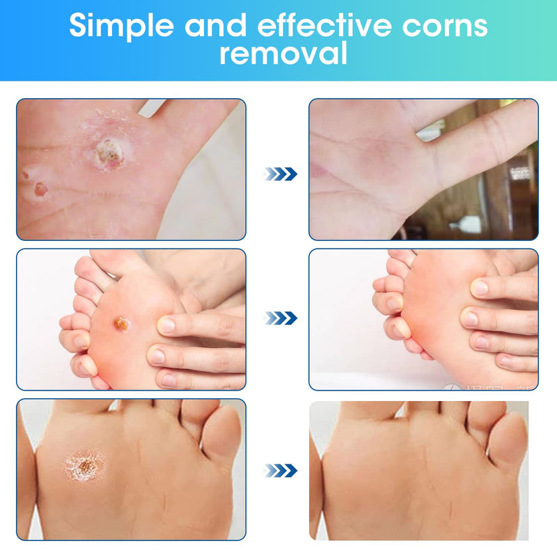 [Australia] - 38 Pcs Corn Removal Pads for Toe,Extra Strength Corn & Callus Remover for Feet & Toes for Adult and Elderly Nurses Hikers and Athletes Men and Women 