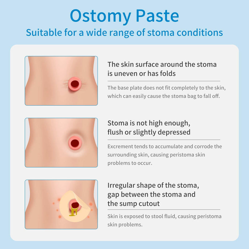 [Australia] - Ostomy Paste, Alcohol-Free Skin Barrier Ostomy Paste, Stoma Care Supplies Osotmy Supplies Accessories,Ostomy Bag Protect Skin Barrier Adhesive & Filler-2.1 Ounce Tube 