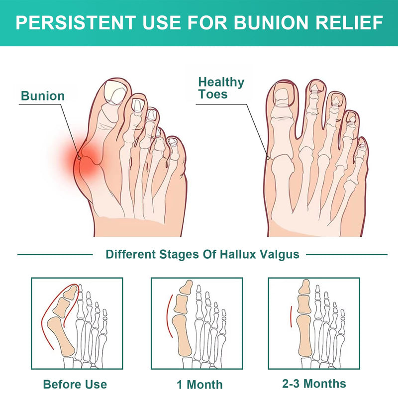 [Australia] - TCASENER 1 pair of hallux valgus socks, hallux valgus bandage for men and women, hallux valgus correction bandage, toe spreader big toe, protection of the ball of the toe 