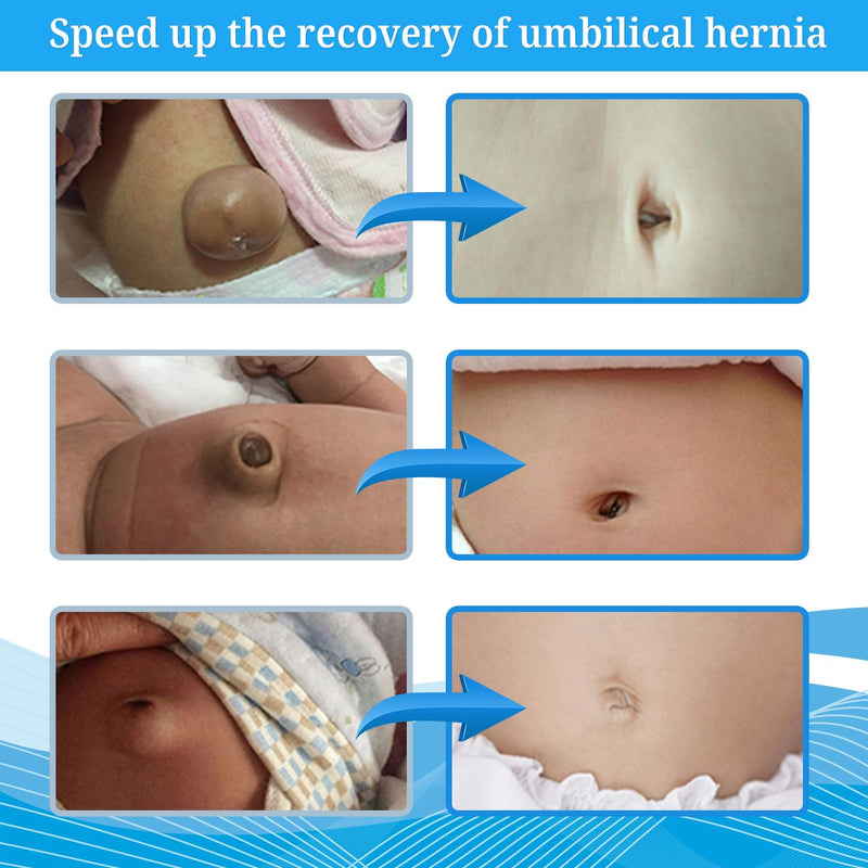 [Australia] - S Baby Belly Band Umbilical Hernia Belt | Belly Button Band Navel Truss Wrap for Newborn/Infant - Soft, Skin-friendly, Adjustable Blue/White 